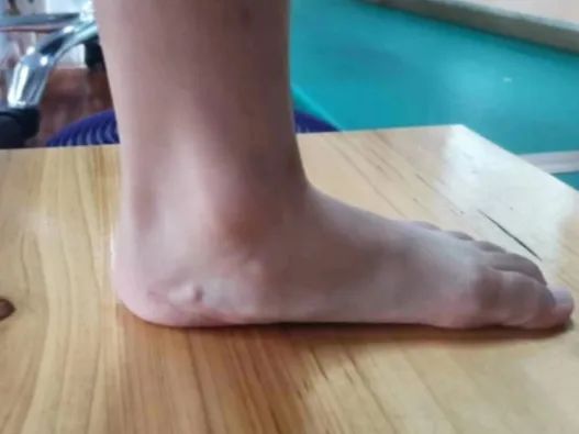 【健康科普】不容小觑的“体态杀手”——扁平足