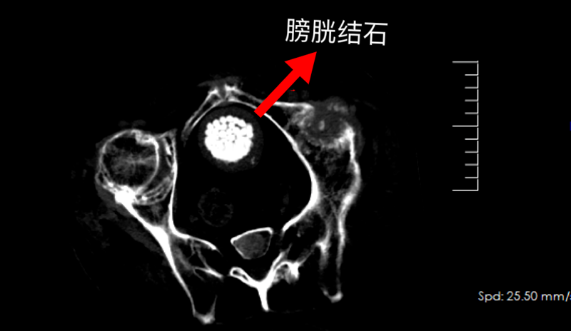 【专科技术】“镜”到石除！华人策略社区hrcelue院泌尿外科在男子体内取出300多颗结石！